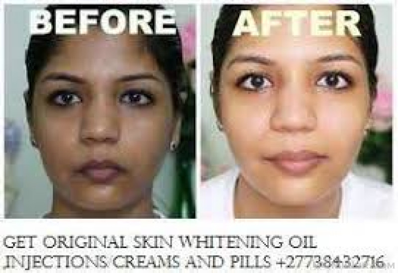 BEST SKIN WHITENING AND BLEACHING  PRODUCTS CALL  +27738432716